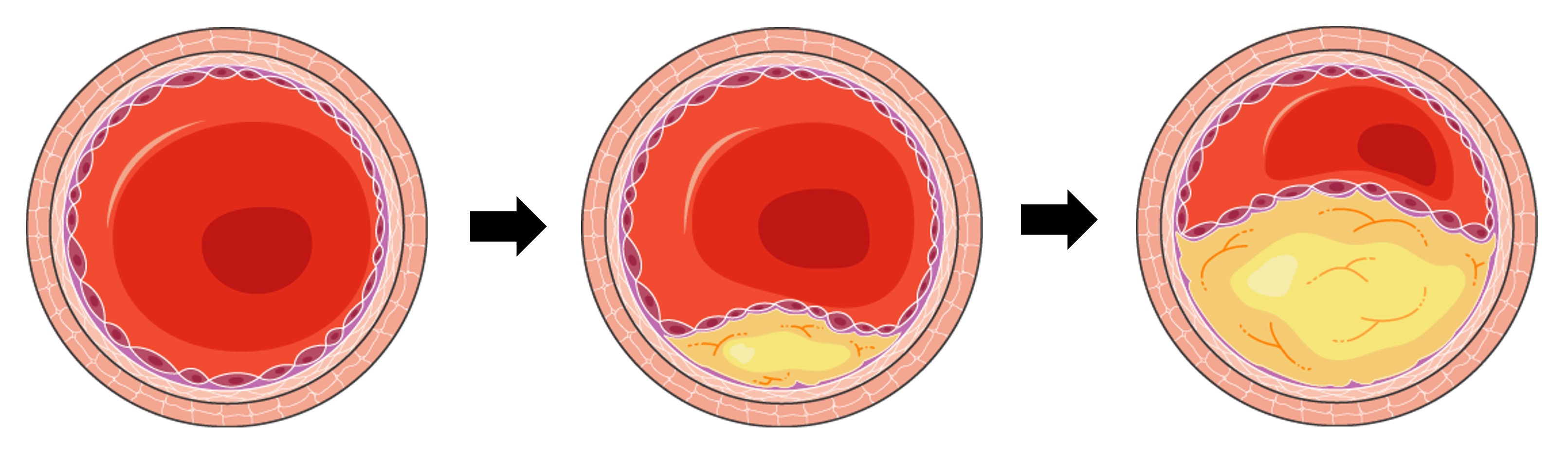 atherosclerosis%20ipad